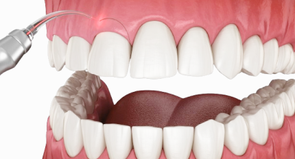 Laser gingival treatment